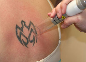 Laser Tattoo Removal - Tattoo Remover - Tattoo Removing Laser - Laser  Surgery Australia